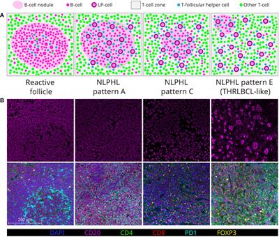 Microenvironmental immune cell alterations across the spectrum of nodular lymphocyte predominant Hodgkin lymphoma and T-cell/histiocyte-rich large B-cell lymphoma